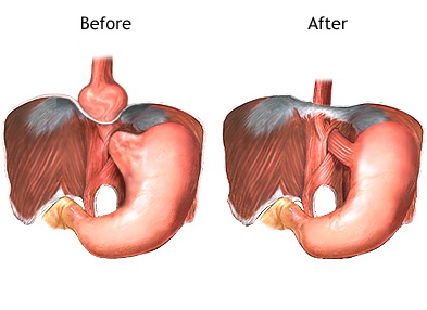 Hiatus hernia tünetei, diéta, kezelés