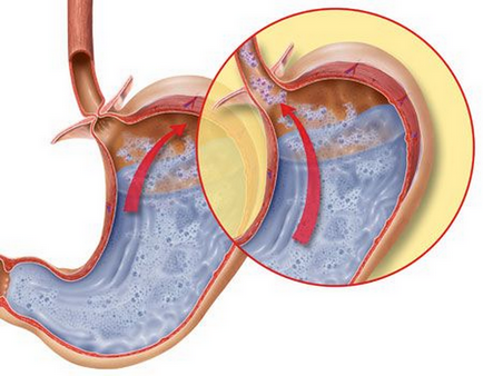 Hiatus hernia tünetei, diéta, kezelés