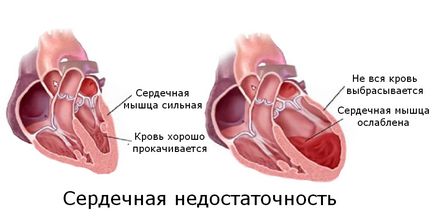 інфаркт легені