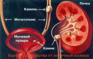 Care sunt simptomele și metodele de tratare a colicii rinichilor?