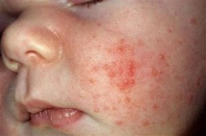 Cum să distingem acneea de nou-născuți de caracteristicile alergiei, diferențele, cauzele apariției, dacă este necesar să le tratăm