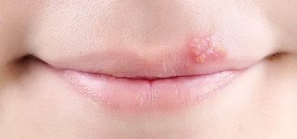 Cum se transmite herpesul pe buzele căii de infecție