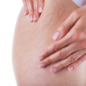 Cum să preveniți vergeturile în timpul prevenirii și tratării sarcinii