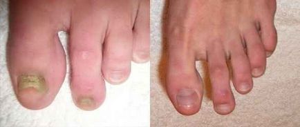 Tratamentul ciupercilor pe unghiile picioarelor cu sulfat de cupru