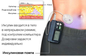 Лікування цукрового діабету 1 і 2 типу в германии