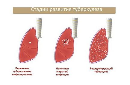 Tratamentul tuberculozei