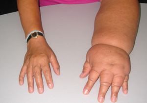 Limfostazom alsó végtagok okait (lymphostasis) Limfostazom alsó végtagok okai