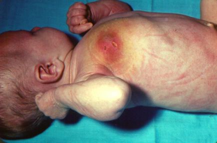 Mastitis gyermekeknél