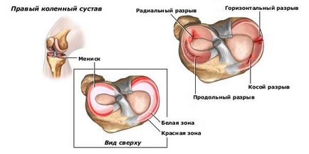 Меніск колінного суглоба лікування без операції і симптоми запалення