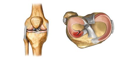 Tratamentul articulației genunchiului meniscus fără intervenție chirurgicală și simptome de inflamație
