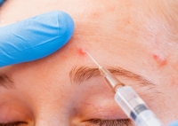 Mezoterapia feței va ușura acneea