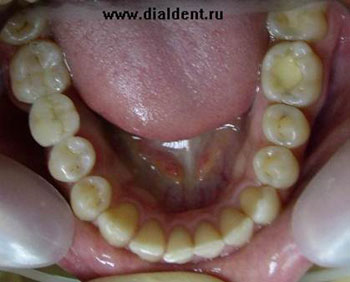 Мостовидной протезування без обточування зубів