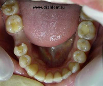 Мостовидной протезування без обточування зубів