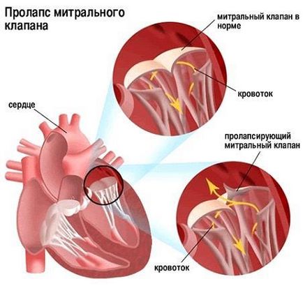 Чи можна займатися спортом при пролапсі мітрального клапана