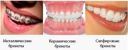 Inele ieftine - cum să alegeți bretele ieftine - portal dentar