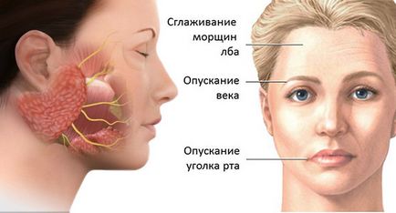 Nevrită a tratamentului nervului facial - frumos la modă