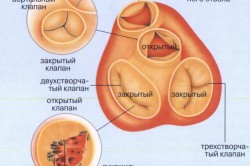 Операції із заміни клапана серця