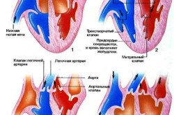 Operații de înlocuire a supapei cardiace