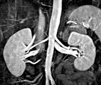 Tumori suprarenale - cauze, simptome, diagnostic și tratament