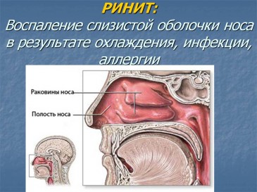 Гострий риніт та боротьба з ним