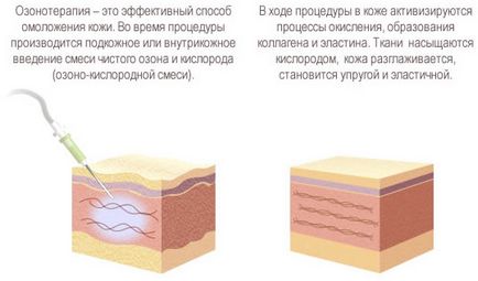 Озонотерапія для особи відгуки, протипоказання, фото до і після, ціни