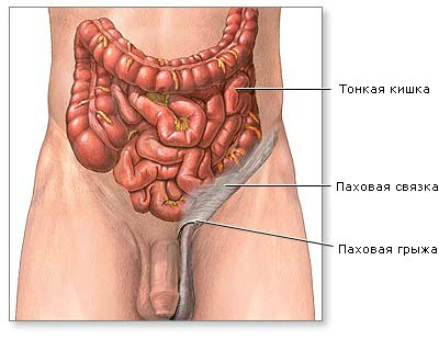 Hernia inghinala la chirurgia si tratamentul barbatilor, dcb im