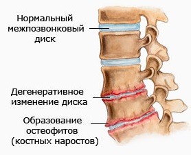 Înotarea cu osteochondroza coloanei vertebrale cervicale