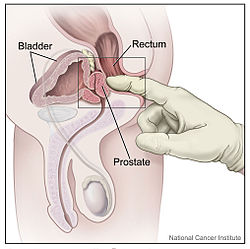 Spaga operatie prostata cfr iasi