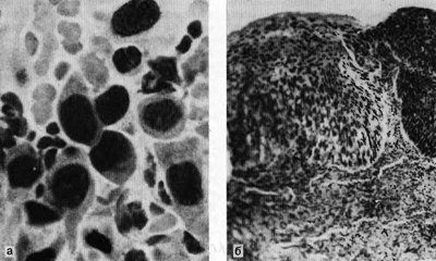 Cancer de col uterin preinvaziv