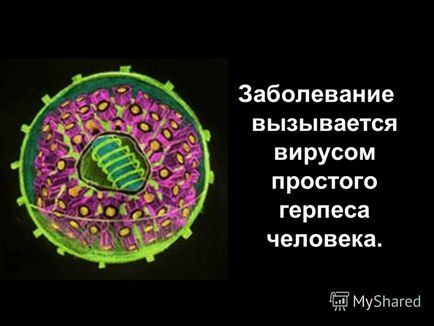 Prezentarea pe tema bolii herpes este cauzată de virusul herpes simplex uman