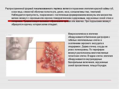 Презентація - простий герпес - завантажити безкоштовно