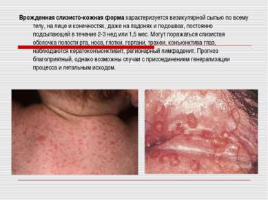 Prezentare - Herpes simplex - descărcare gratuită