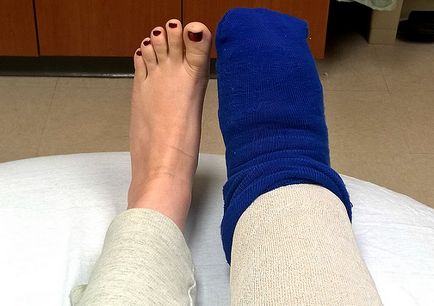 Причини і лікування лімфостазу нижніх кінцівок, що таке вторинний лімфостаз ніг
