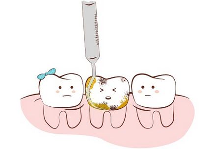 Причини появи і основні методи видалення зубного каменю