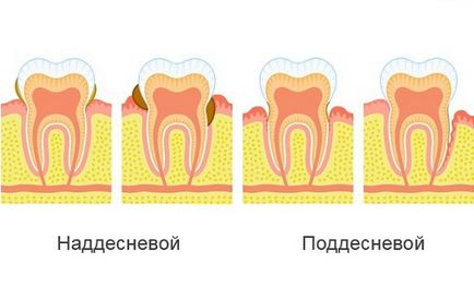 Причини появи і основні методи видалення зубного каменю