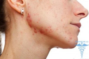 Прищі на обличчі шиї причини лікування