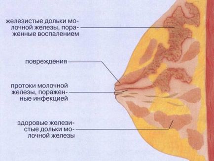 Простудила груди під час гв що робити