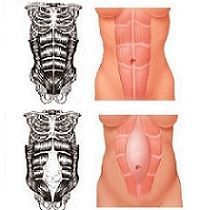 Diferența dintre mușchii abdominali în timpul sarcinii este modul de revenire a unei siluete subțiri