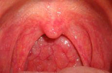 Stenoza cirotică a laringelui