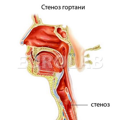 Рубцевий стеноз гортані - хвороби вуха, горла і носа - медична енциклопедія