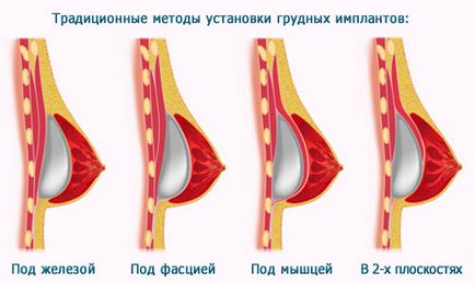 Силіконова груди все, що потрібно знати до операції