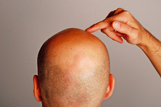 Súlyos hajhullás nőknél okoz, kezelési módszerek