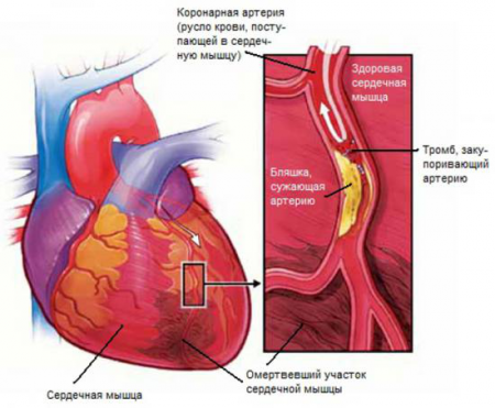 Симптоми інфаркту у чоловіків