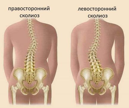 Сколіоз у дитини і дорослого