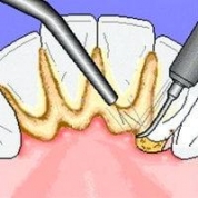 Metode moderne de îndepărtare a tartrului