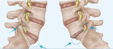 Spondylolisthesis ágyéki gerinc kezelés, a tünetek