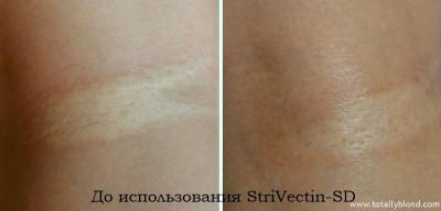 Strivectin-SD este capabil să scape de cicatricile vârfului