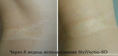 Strivectin-sd здатний крем позбавити від шрамів відгук, на