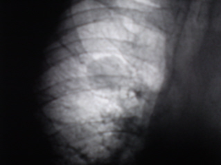 Tela-infarct-pneumonie, portal de radiologi