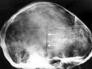 Structura normală a oaselor întunecate și variantele de patologie